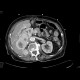 Renal cell carcinoma, recurrence, metastases: CT - Computed tomography