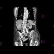 Renal cell carcinoma, recurrence, metastases: CT - Computed tomography