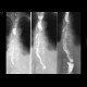 Oesophagus tumor, recurrence, fistulae: X-ray - Plain radiograph