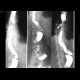 Oesophagus tumor, recurrence, fistulae: X-ray - Plain radiograph