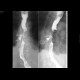 Oesophagus tumor, recurrence, fistulae: X-ray - Plain radiograph