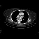 Oesophagus tumor, recurrence, fistulae: CT - Computed tomography