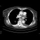 Oesophagus tumor, recurrence, fistulae: CT - Computed tomography