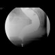 Rectocoele with ulcer, intussusception: RF - Fluoroscopy
