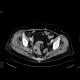 Necrotic tumor of rectosigmoid junction, fistulisation into thigh: CT - Computed tomography