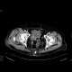 Necrotic tumor of rectosigmoid junction, fistulisation into thigh: CT - Computed tomography