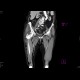 Necrotic tumor of rectosigmoid junction, fistulisation into thigh: CT - Computed tomography