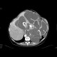 Abdominal sacroma: CT - Computed tomography