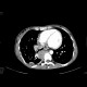 Sacroma of chest wall: CT - Computed tomography