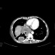 Sacroma of chest wall: CT - Computed tomography