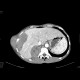 Sacroma of chest wall: CT - Computed tomography