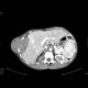 Sacroma of chest wall: CT - Computed tomography