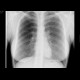 Septic emboli, lung: X-ray - Plain radiograph