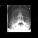 Acute sinusitis, maxillary sinus: X-ray - Plain radiograph