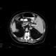 Situs viscerum inversus: CT - Computed tomography