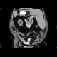 Situs viscerum inversus: CT - Computed tomography