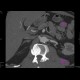 Stenosis of renal artery: CT - Computed tomography