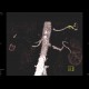 Stenosis of renal artery: CT - Computed tomography