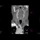 Stenosis of internal carotid artery: CT - Computed tomography