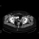 Tumorous stenosis of sigmoid colon: CT - Computed tomography
