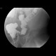 Tumorous stenosis of sigmoid colon: RF - Fluoroscopy
