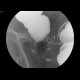 Tumorous stenosis of sigmoid colon: RF - Fluoroscopy