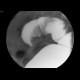 Blind stenosis of sigmoid colon, ileus: RF - Fluoroscopy