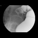 Blind stenosis of sigmoid colon, ileus: RF - Fluoroscopy