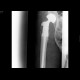 Scrotal hernia, hip joint replacement: X-ray - Plain radiograph