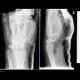 Fracture of scaphoid bone, perilunar subluxation: X-ray - Plain radiograph