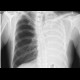 Pneumonectomy: X-ray - Plain radiograph