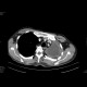 Pneumonectomy: CT - Computed tomography