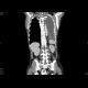 Pneumonectomy: CT - Computed tomography