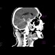 Subarachnoid hemorrhage: CT - Computed tomography