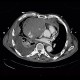 Cardiac tamponade, mediastinal hematoma, dissection of truncus brachiocephalicus: CT - Computed tomography