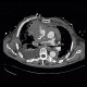 Cardiac tamponade, mediastinal hematoma, dissection of truncus brachiocephalicus: CT - Computed tomography