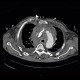 Cardiac tamponade, mediastinal hematoma, dissection of truncus brachiocephalicus: CT - Computed tomography