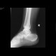 Fracture of calcaneus, comminuted: X-ray - Plain radiograph