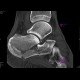 Fracture of calcaneus, comminuted: CT - Computed tomography