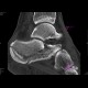 Fracture of calcaneus, comminuted: CT - Computed tomography