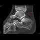 Fracture of calcaneus, comminuted: CT - Computed tomography