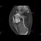 Fracture of calcaneus, comminuted: CT - Computed tomography