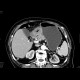 Carcinoma of stomach, antrum: CT - Computed tomography