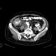 Carcinoma of cecum, necrotic lymph node: CT - Computed tomography