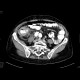 Carcinoma of cecum, necrotic lymph node: CT - Computed tomography