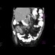 Carcinoma of cecum, necrotic lymph node: CT - Computed tomography