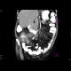 Carcinoma of cecum, necrotic lymph node: CT - Computed tomography