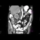 Carcinoma of cecum, necrotic lymph node: CT - Computed tomography