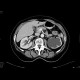 Tumour of the cervix of uterus, hydronephrosis: CT - Computed tomography