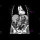 Tumour of the cervix of uterus, hydronephrosis: CT - Computed tomography